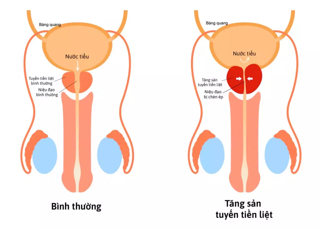 Prostanix Có tốt không? Giá bao nhiêu? Mua ở đâu chính hãng?