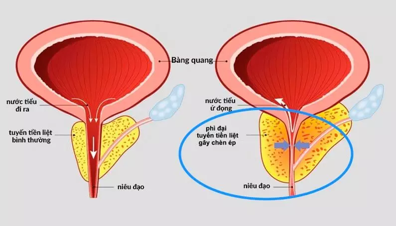 Prostanix Có tốt không? Giá bao nhiêu? Mua ở đâu chính hãng?