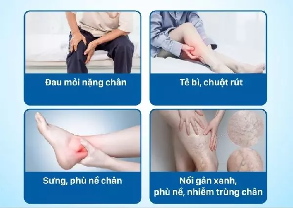 Thuốc trị suy giãn tĩnh mạch