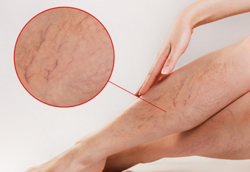 Suy giãn tĩnh mạch ở chân
